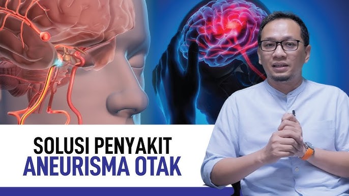 Tahu Aneurisma Otak?  Ini 5 Tips Untuk Melindungi Diri Dari Aneurisma Otak Berdasarkan Saran Ahli Saraf