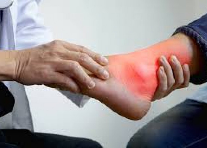 Ternyata Ini Makanan yang Menyebabkan Asam Urat Kambuh