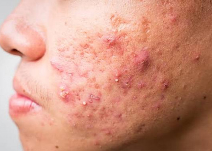 3 Kebiasaan Sepele yang Bikin Jerawat Awet di Wajah