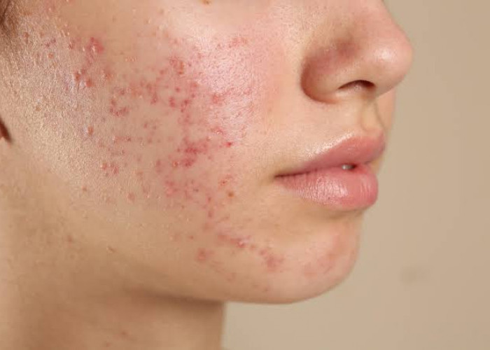 Cokelat dan Gorengan Penyebab Jerawat, Mitos atau Fakta?