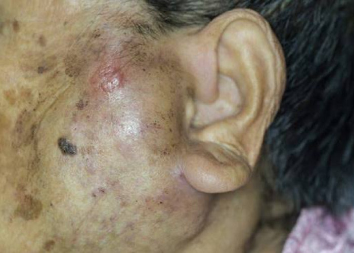 Kenali Jenis Jerawatmu,  Tidak Semua Benjolan Itu Sama