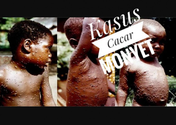 Waspada Kasus Cacar Monyet di Indonesia Terus Meningkat, Bisa Sebabkan Kematian