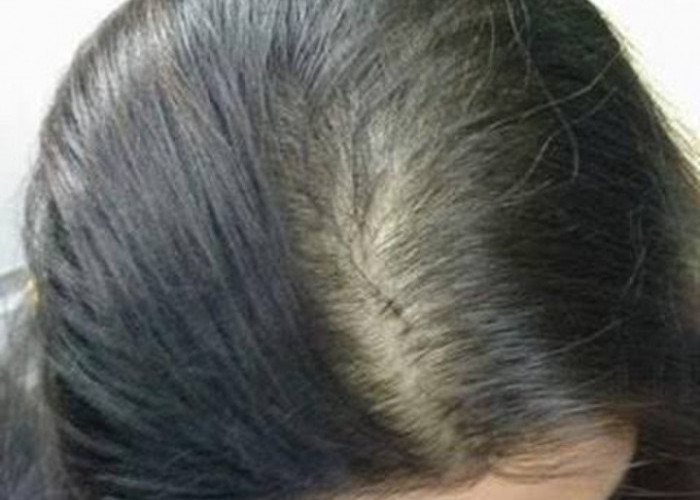 6 Solusi Alami untuk Membantu Mengatasi Rambut Rontok Menurut Jennifer Ashton