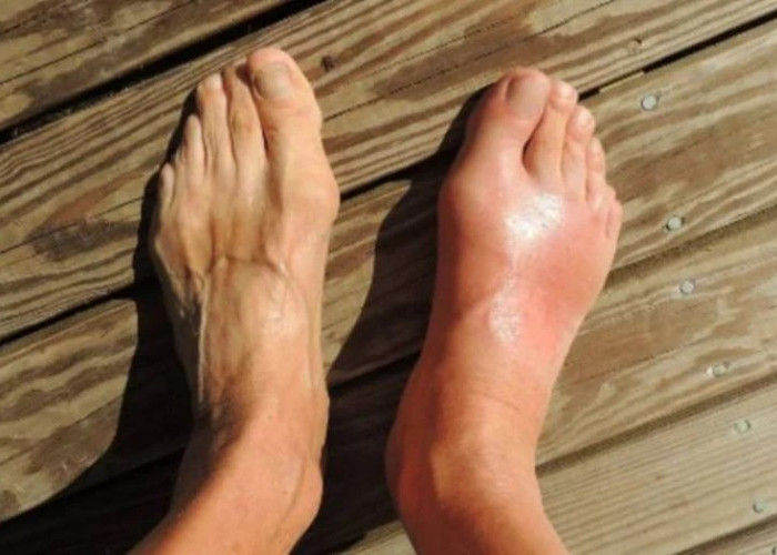 7 Minuman yang Dapat Menurunkan Gejala Asam Urat