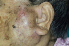 Kenali Jenis Jerawatmu,  Tidak Semua Benjolan Itu Sama