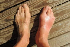 7 Minuman yang Dapat Menurunkan Gejala Asam Urat